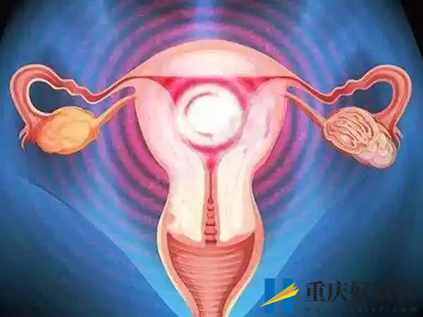 子宫肌瘤做试管婴儿适合哪种促排方案(图1)