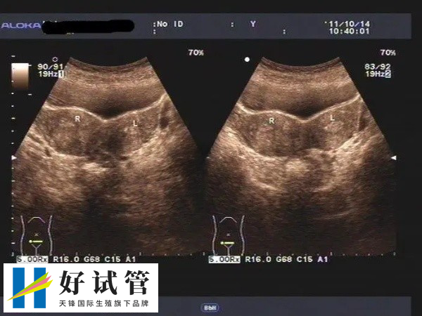 荆州中心医院试管不一定生双胞胎