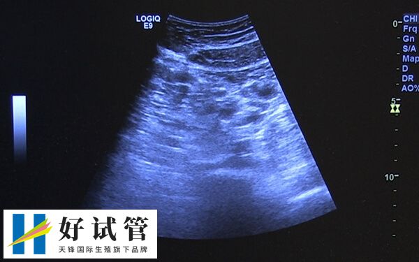 卵巢功能减退会影响卵泡发育