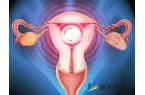 子宫肌瘤做试管婴儿适合哪种促排方案